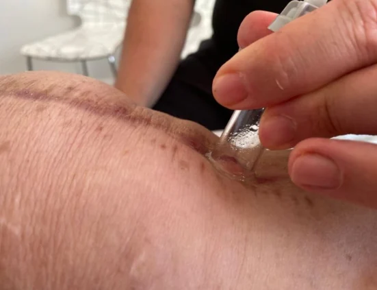Detalle de tratamiento de fisioterapia invasiva en Health & Motion